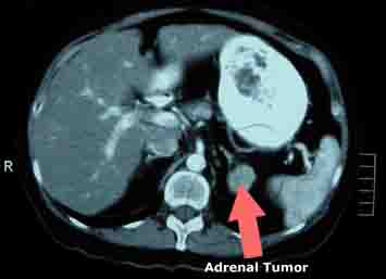 Thyroid anabolic steroids