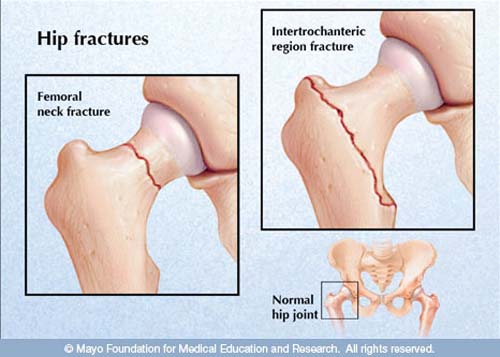 fracture