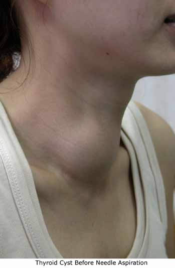 thyroid_cyst